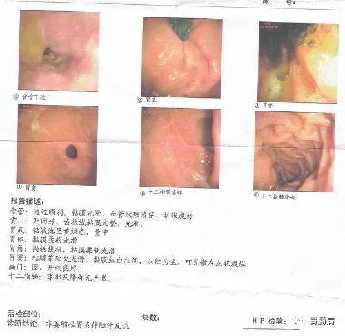 萎缩性胃炎与胃癌的关系,萎缩性胃炎与胃癌的症状区别