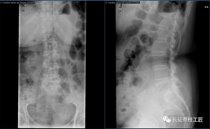 老年人腰椎管狭窄可以微创手术吗,老年人腰椎管狭窄瘫痪