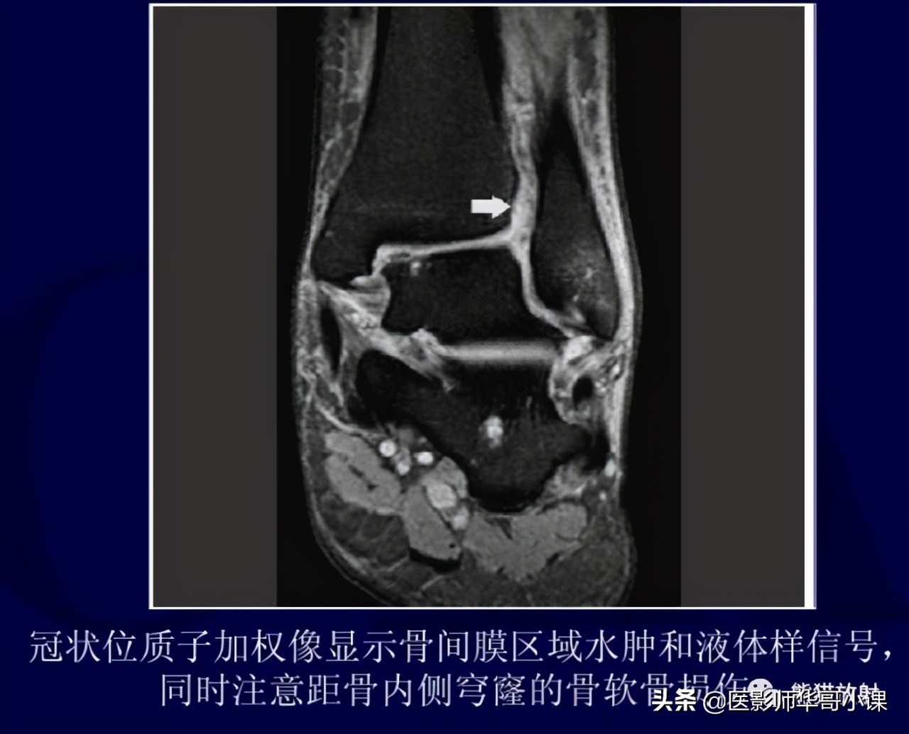 踝关节解剖视频课,解剖学韧带分布图