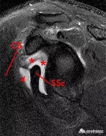 肩关节滑膜解剖,肩关节周围肌肉解剖
