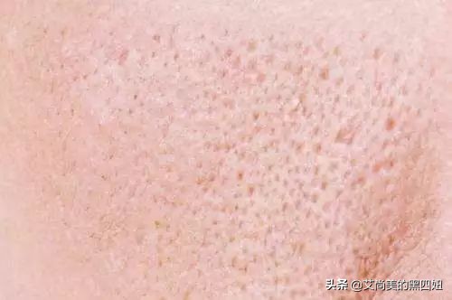 鼻子毛孔粗大在家怎么收缩毛孔,毛孔粗大收缩毛孔最快有效的方法