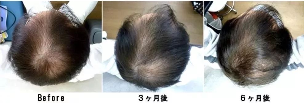 “十男八秃”的日本男人疯抢这瓶小黑钻!让头发不再掉了