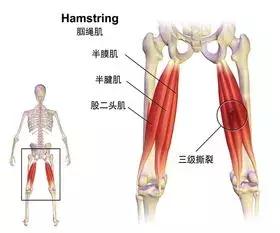 腿筋拉伤是不是腘绳肌拉伤,大腿内侧筋拉伤怎么处理