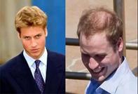 这么吃，最容易掉头发....