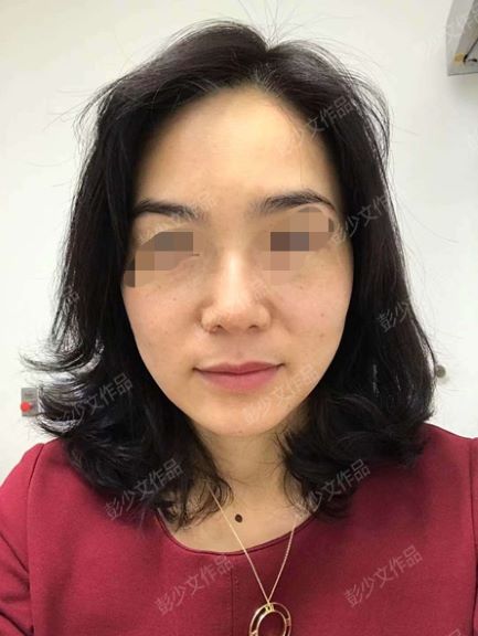 去除雀斑的有效方法是什么呢,祛雀斑和黄褐斑最好的方法