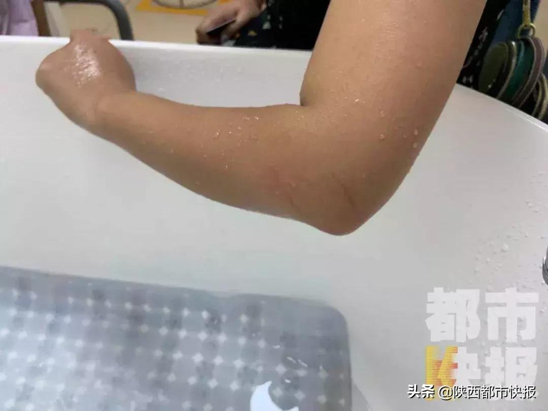 家里突然冒出这东西，西安一女子凌晨起夜被抓伤！医生：一旦发病死亡率很高