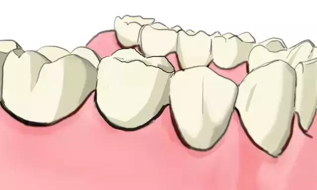镶牙手绘图,镶牙图片过程