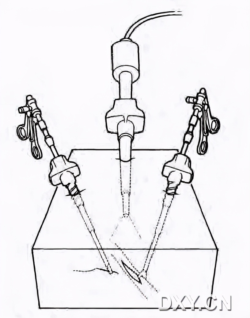 腹腔镜下切割缝合器使用视频,腹腔镜下缝合教程