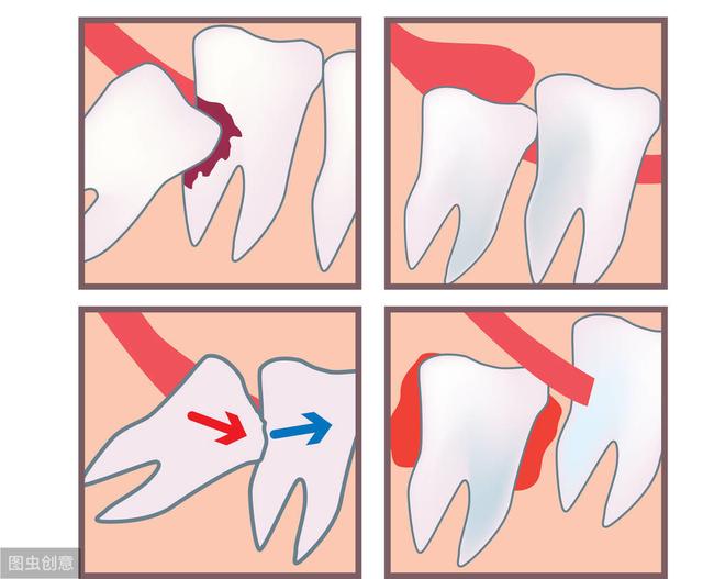阻生智齿完全埋在牙龈里,牙龈下面的阻生智齿需要拔么