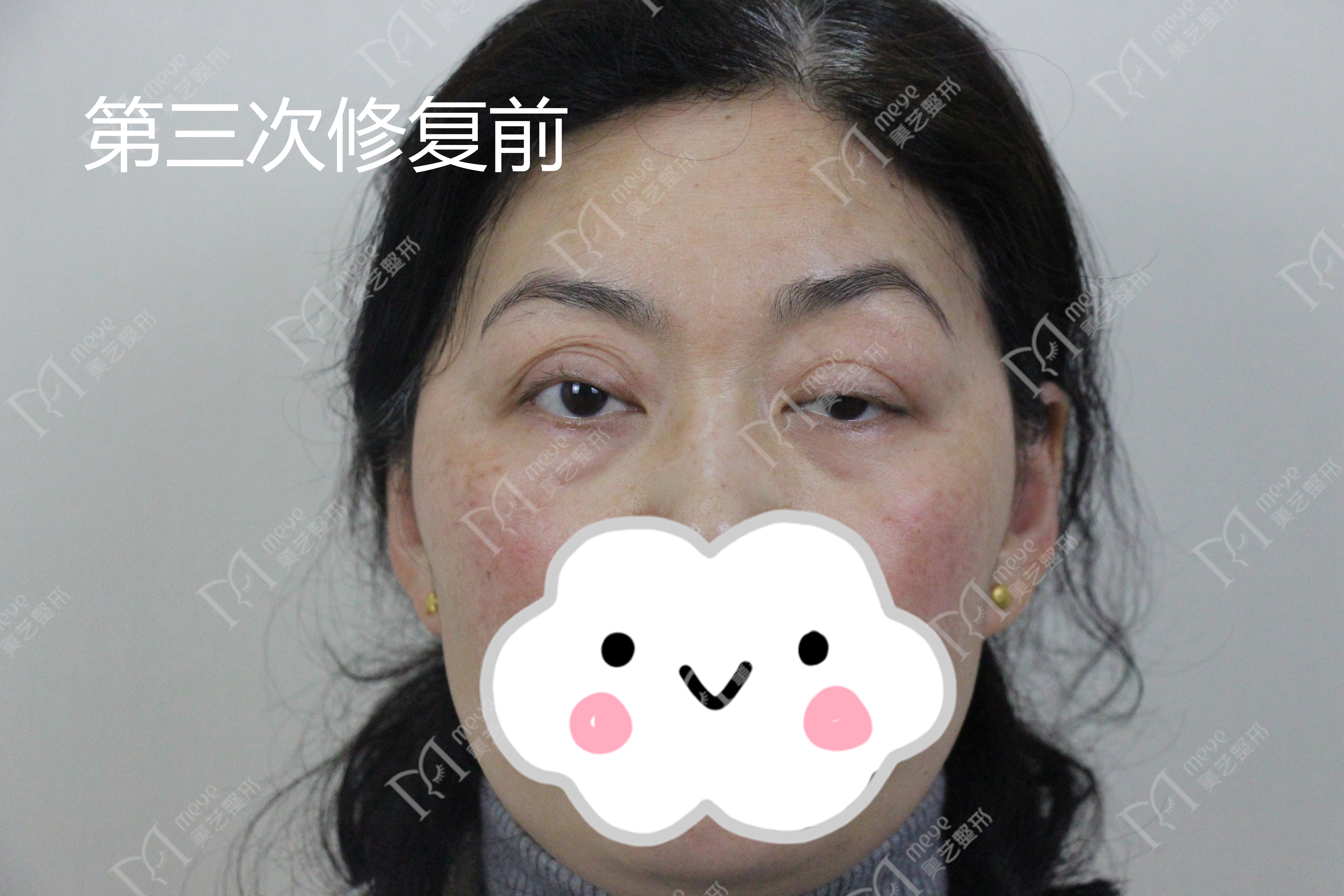 三眼皮显老气吗,三眼皮真的很好看吗