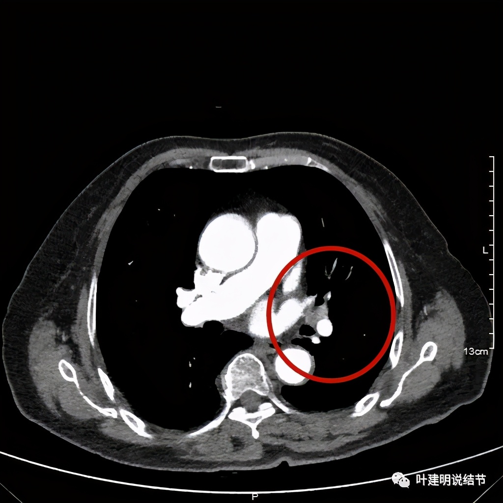 卡瑞利珠单抗治疗肺鳞癌有用吗,特瑞普利单抗对鳞癌治疗有效吗