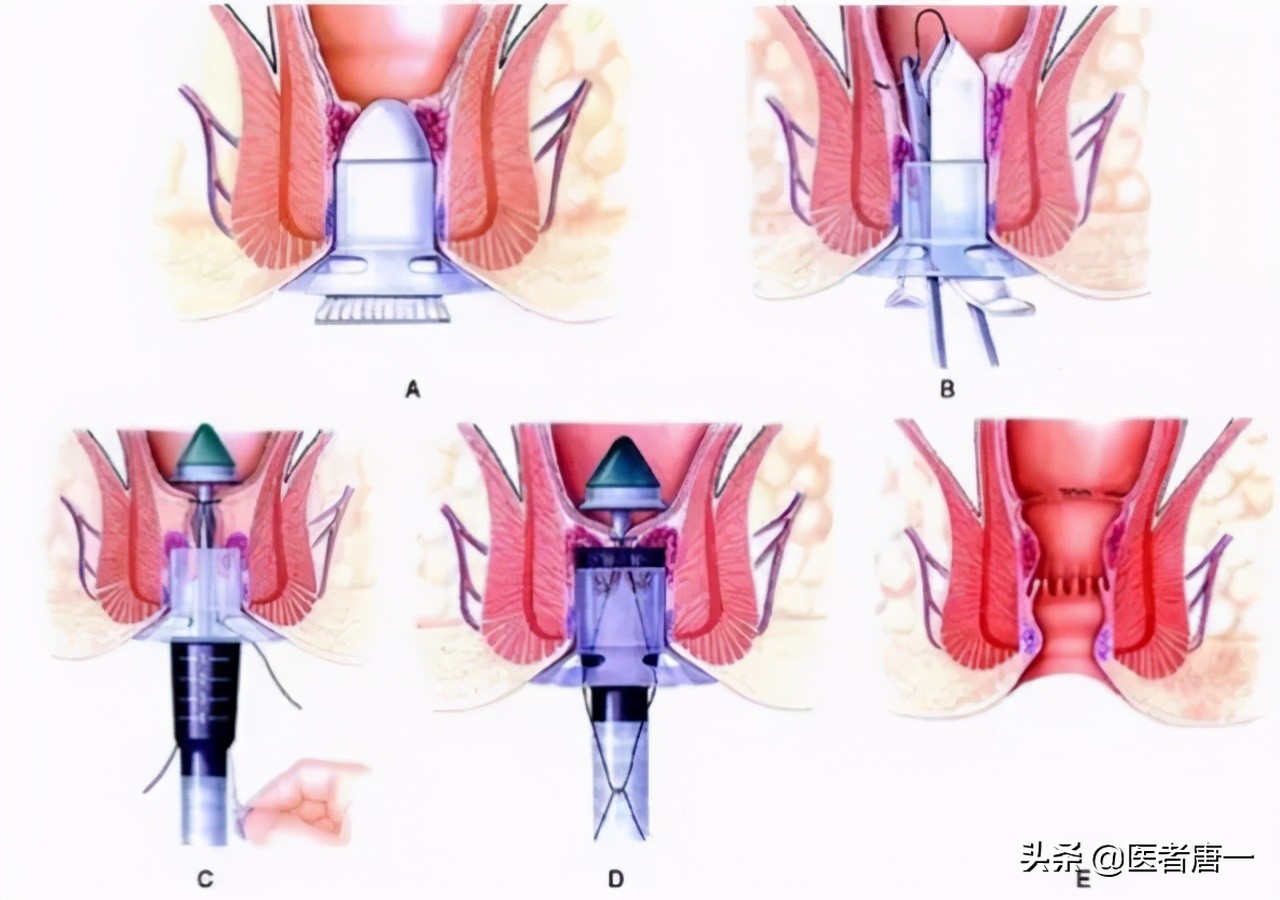 别不好意思做：提肛运动真的很养生，每天做几分钟，男女都受益