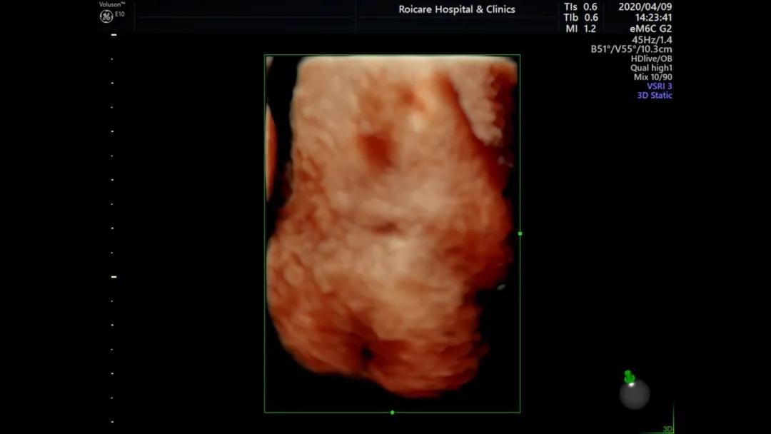 胎儿期发现脊髓圆锥位置低的临床指导