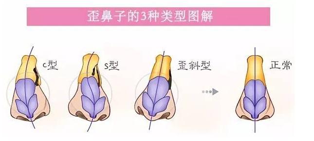 余文林鼻子修复方法,余文林修复嘴唇怎么样