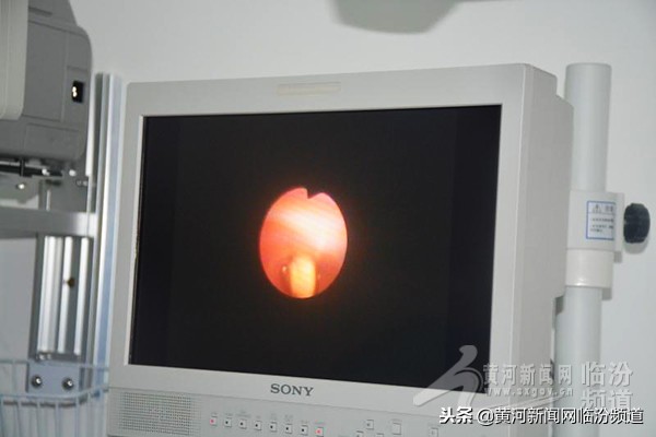 气管镜下异物取出术案例分析,支气管镜取出异物视频