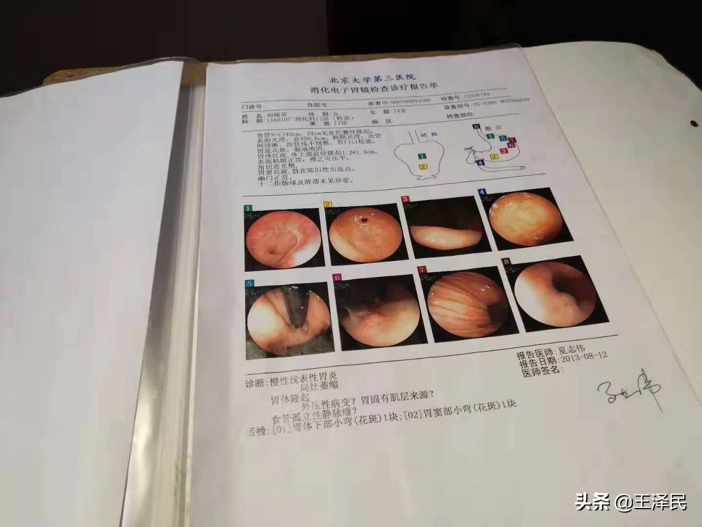 30多年胃病一年犯几次怎么办,30多年的老胃病太难治