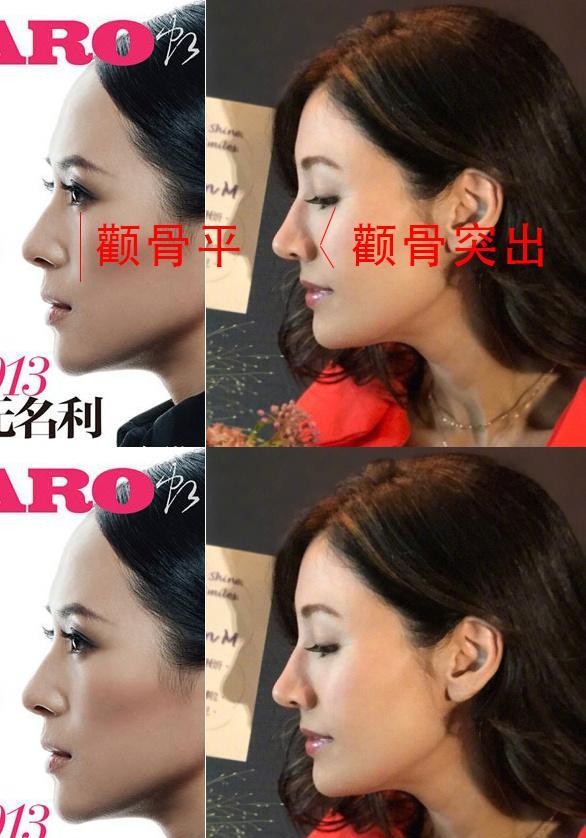 颧骨高适合什么修饰,颧骨塑造