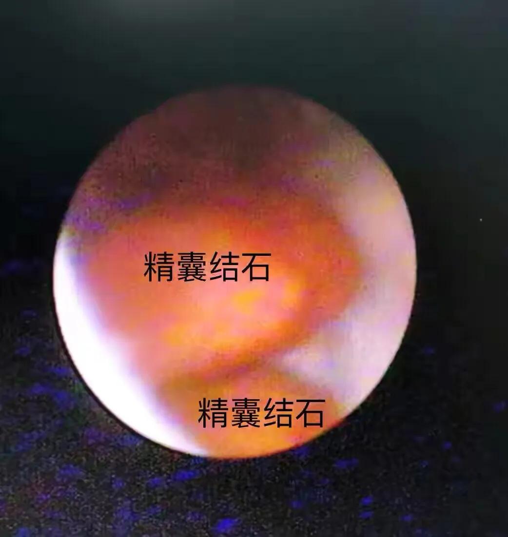 前列腺钙化灶可以用冲击波治疗吗,前列腺钙化灶尿频尿痛怎么治疗