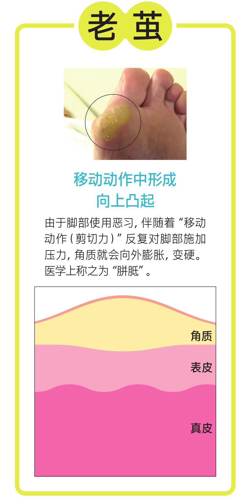 脚底的老茧怎么才能根治,老茧下的鸡眼