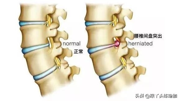 瑜伽缓解腰椎病的动作,治疗腰椎突出的瑜伽姿势
