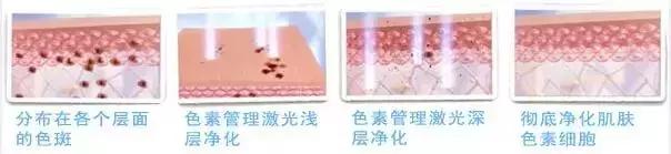 激光祛斑后会复发吗会产生反弹吗,激光祛斑复发