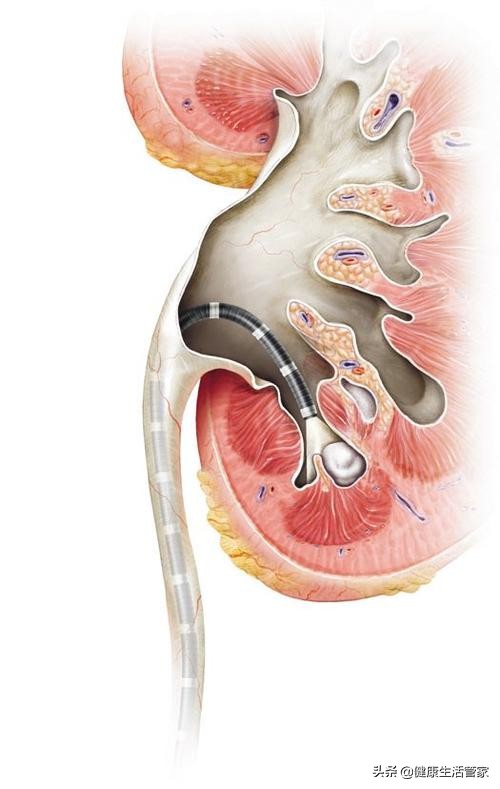 怎么断定得了尿路结石,得了尿道结石什么症状