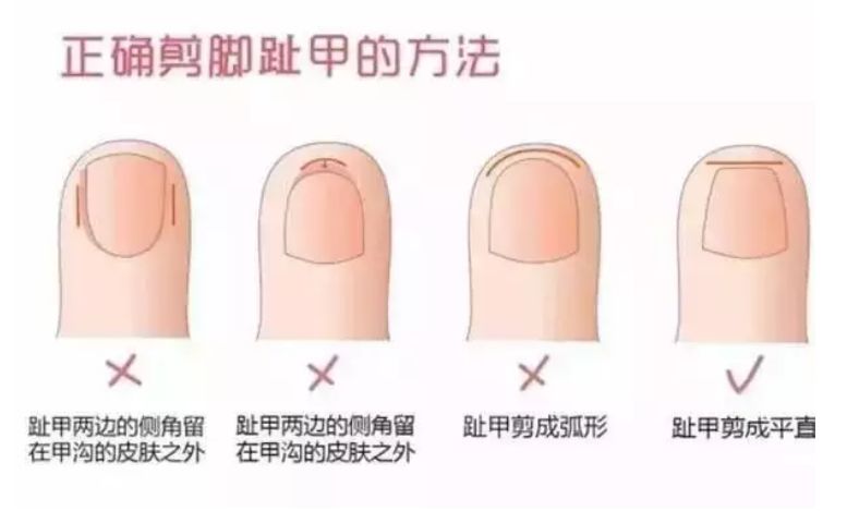 宝宝脚趾甲长到肉里怎么办,宝宝的脚趾总是弯着