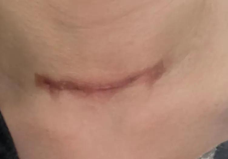 甲状腺疤痕增生吃什么食物淡化,甲状腺疤痕增生如何消除增生