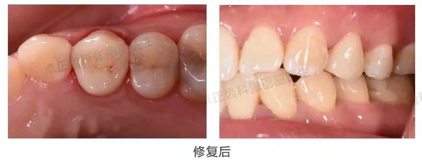 牙齿缺损全瓷冠修复多少钱,牙齿楔状缺损修复大概多少钱