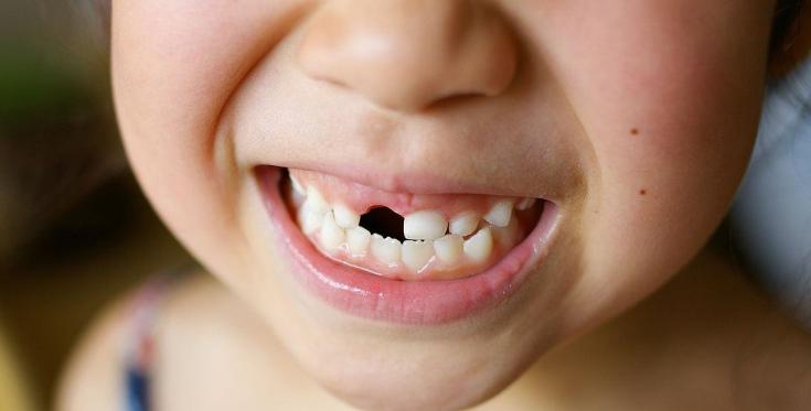 孩子换牙期当心这些问题毁颜值,儿童换牙期家长需要注意什么问题