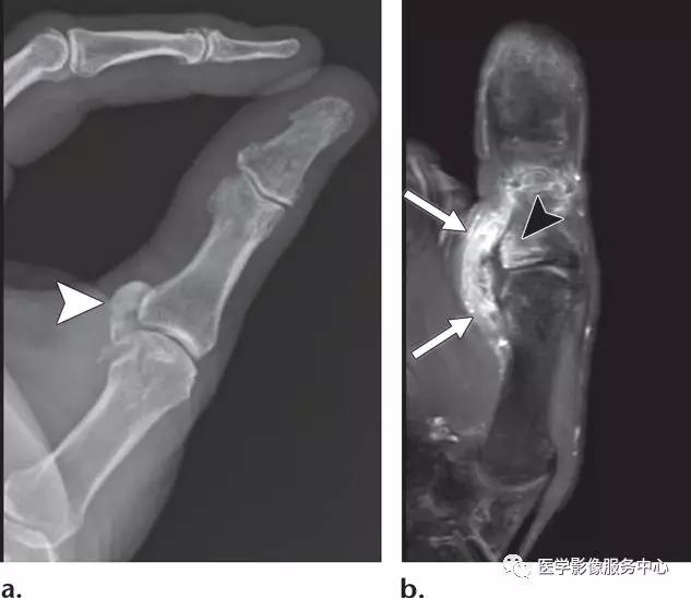 手腕撕脱性骨折一年了还隐隐作痛,手腕三角骨撕脱骨折症状有哪些