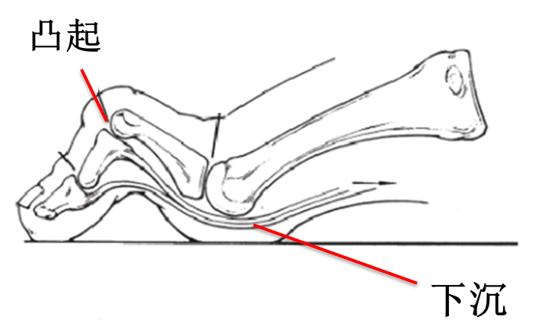 老年人拇外翻怎么回事,老人拇外翻最近痛是什么原因呢