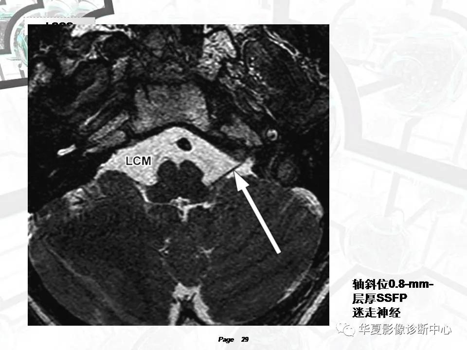 磁共振颅神经扫描是定位在哪,颅神经图谱