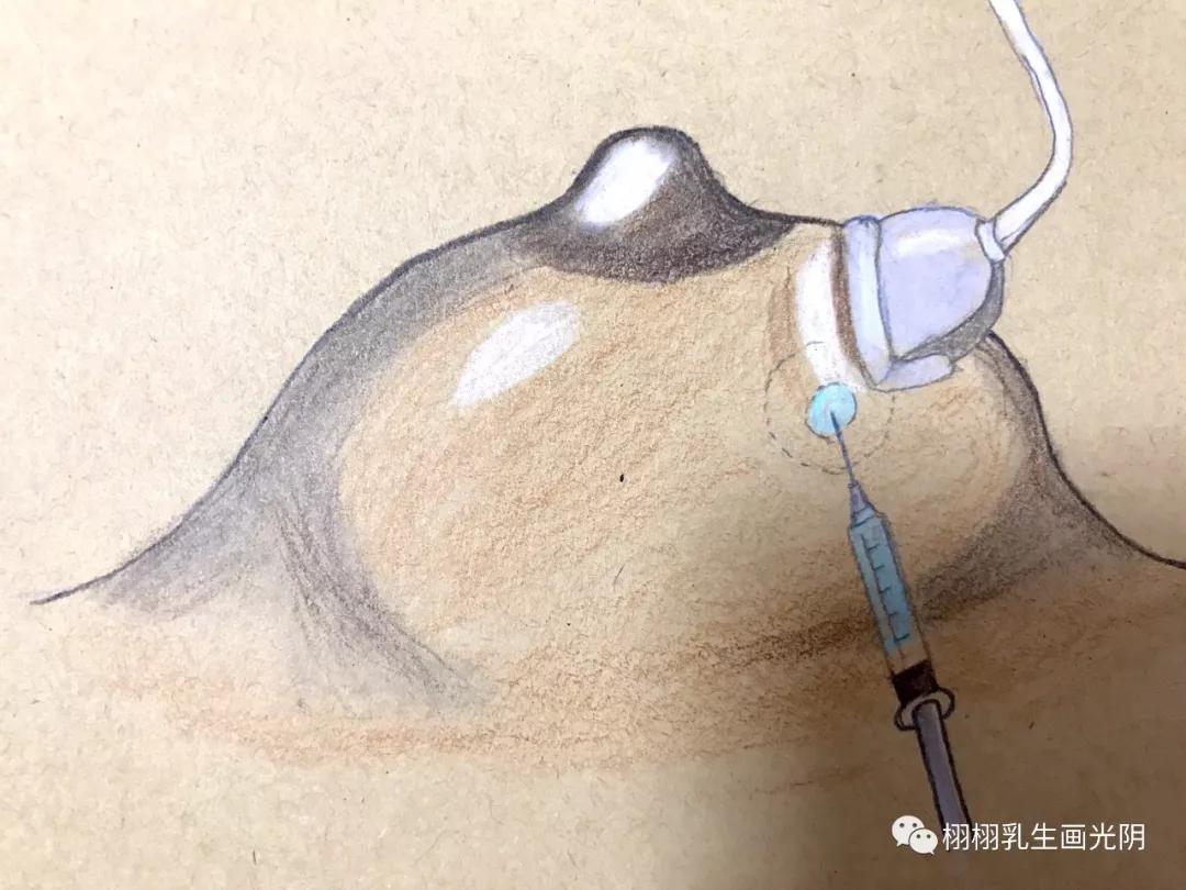 乳腺囊肿为什么会得这个病,乳腺囊肿的科普