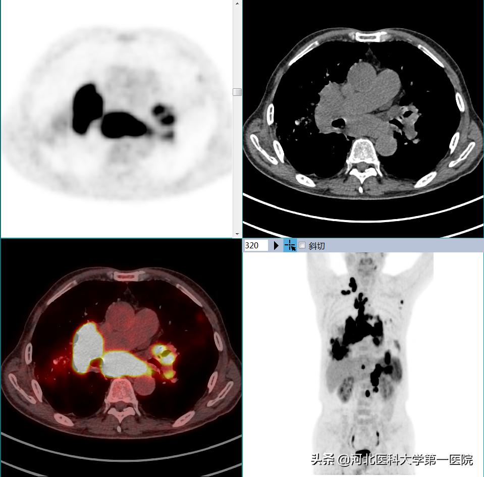 精准、全面诊断肿瘤病灶，河北医大一院PET-CT大显神威
