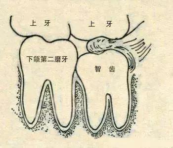 水平阻生智齿一定要拔掉吗,嘴里长了智齿一定要拔掉吗