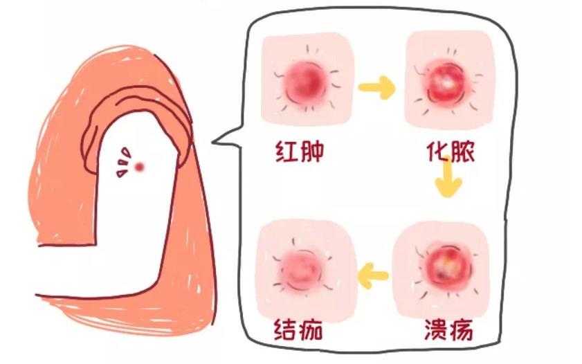 接种乙肝疫苗后会有什么不良反应,13价肺炎疫苗接种后的不良反应