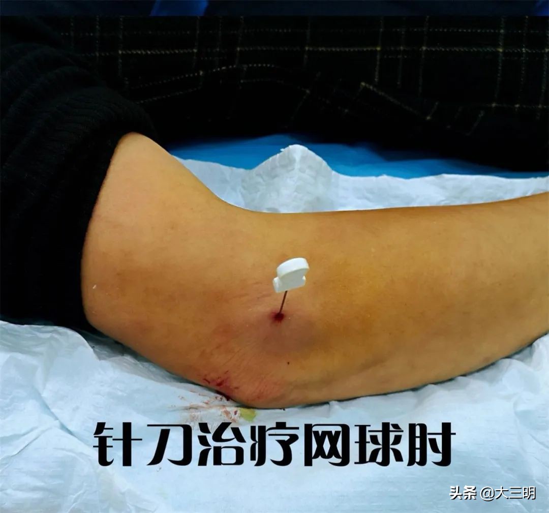 顽固性网球肘的敲打治疗,网球肘针刀效果怎么样