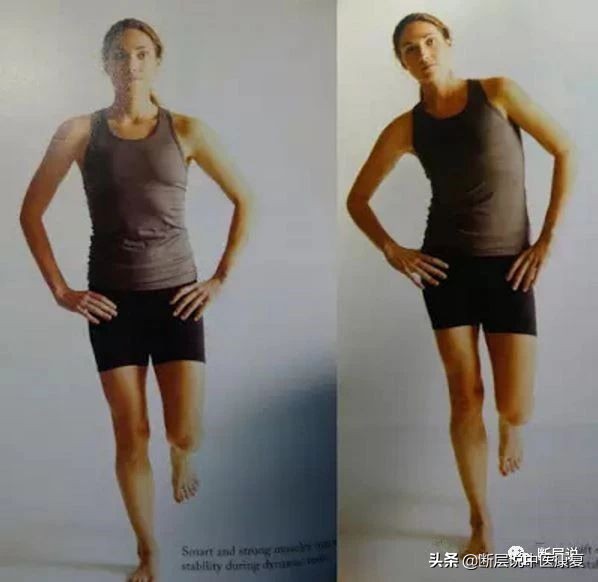 腰痛、膝痛、髋关节失稳？都是臀中肌无力惹的祸