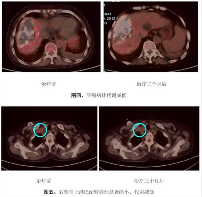 癌症转移无症状,癌症全身转移抗癌成功案例
