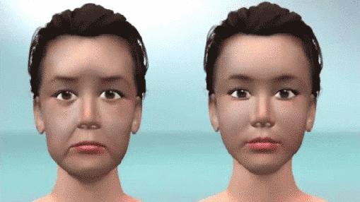 法令纹凸显怎么办,胖起来泪沟和法令纹会减轻吗