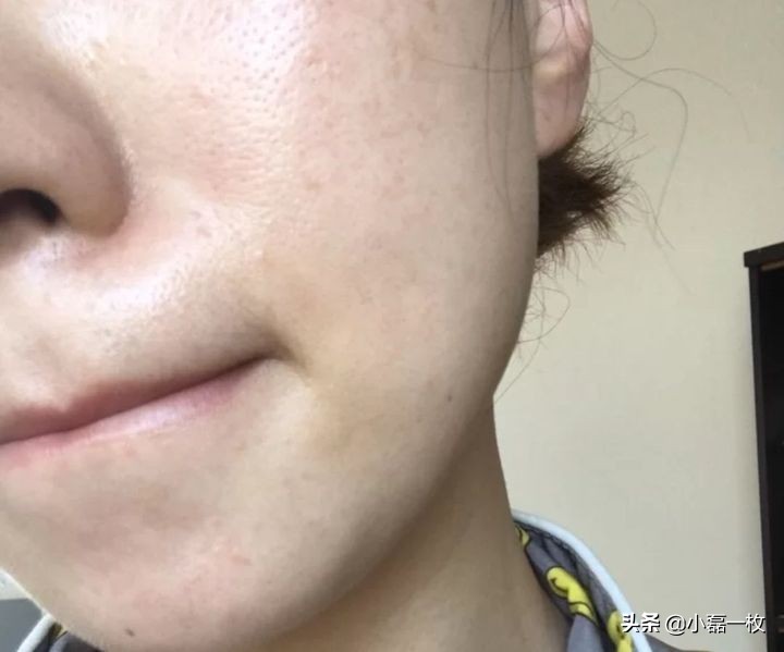 真正有效的祛痘印产品推荐,有什么很好的祛痘印产品