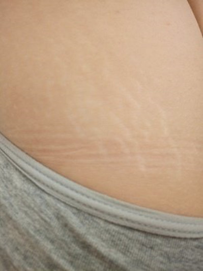 孕妈妈妊娠纹怎么缓解,孕妈妈长纹了怎么办