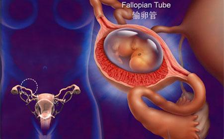 b超检查说是盆腔积液是怎么回事,b超显示确认妊娠盆腔积液