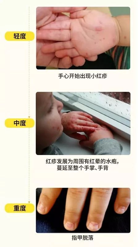 多地流感病人爆发如何预防,如何预防下一场流行病的爆发