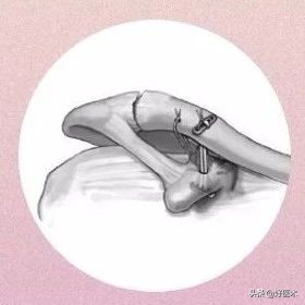 肩锁关节脱位手术后多久可以喝酒,肩锁关节脱位钢板内固定步骤记录