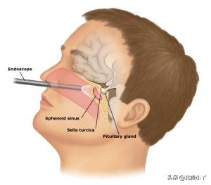 小丫说医｜一类影响全身的特殊脑瘤——“尽管罕见，但不能忽视”