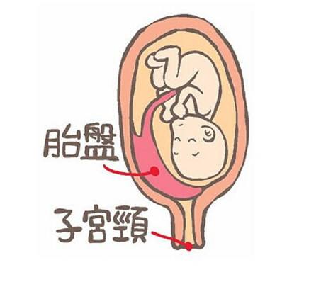 胎盘前置很危险孕妈千万要当心,完全性前置胎盘高危风险等级