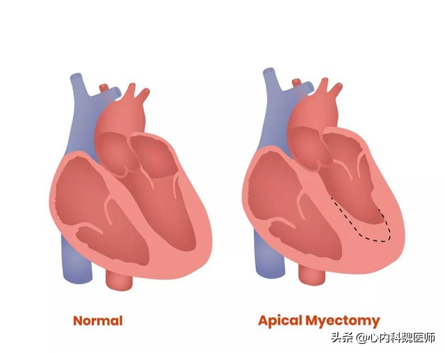 坎地沙坦老年人,适合老年人的降压药缬沙坦