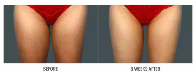 酷塑冷冻溶脂副作用是什么样的,酷塑冷冻溶脂的真实经历对比